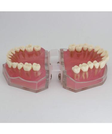 Samnuerly 28 Removable Teeth Dental Implant Model - Translucent Standard for Research & Teaching - Ideal for Removable Lower Jaw - Buy Online on GoSupps.com