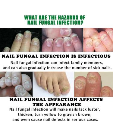 dizhenhui104jiaju LYEAA Nail fungus treatment 7 days nail fungus treatment toenails cuticle care oil ginger nail serum nail strengthening oil for damaged nails 2 pieces - Buy Online on GoSupps.com