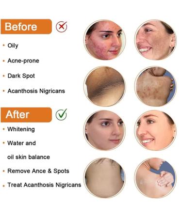 BIERELAOZI Skinenjoy Cleansing Lotion for Acne & Spots - Acanthosis Nigricans Therapy Cream | Dark Spot Remover for Face & Body (1 PC) - Buy Online on GoSupps.com