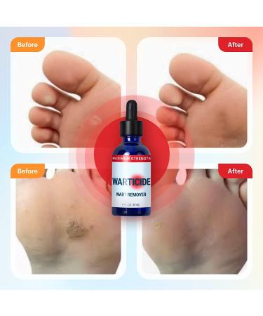 WARTICIDE Fast-Acting Wart Remover - Plantar and Genital Treatment - Easy Application - 1 Fl Oz - Buy Online on GoSupps.com
