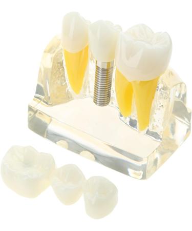 Implant Model Removable Bridge - Educational Teeth Model for Dental Studies | Perfect for Demonstration Classes - Buy Online on GoSupps.com