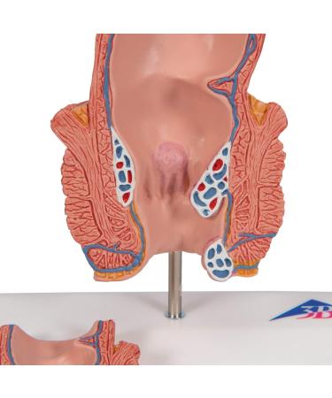 3B Scientific K27 Hemorrhoid Model with Smart Anatomy | Educational Tool - Buy Online on GoSupps.com