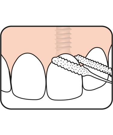 Tepe Bridge & Implant Flowed - 30 Pieces | International Shipping Available - Buy Online on GoSupps.com