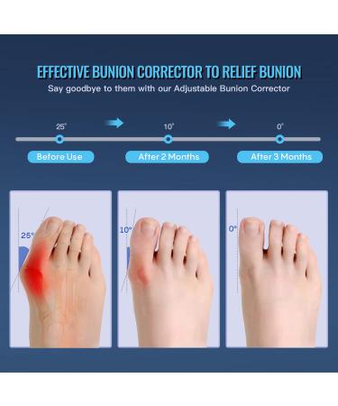 Fit Geno Upgraded Bunion Corrector - 2 Pcs Non-Surgical Toe Corrector for Hallux Valgus Pain Relief - Comfortable & Breathable - Day/Night Support for Men & Women - Buy Online on GoSupps.com