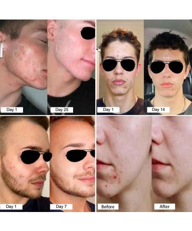 TSYIDUI Acne & Redness KillerAcne BalmRedness Relief BalmGentle Acne Face CreamAcne Remove Skin Care SetAcne Clearing Cream For Teens AdultsSkin Soothing Cream 2pcs - Buy Online on GoSupps.com