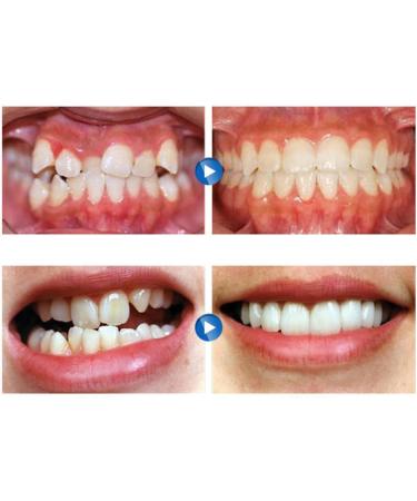 Set of 5 Transparent Mouth Guards for Teeth Grinding - Night Guard for Sleep Support - Buy Online on GoSupps.com