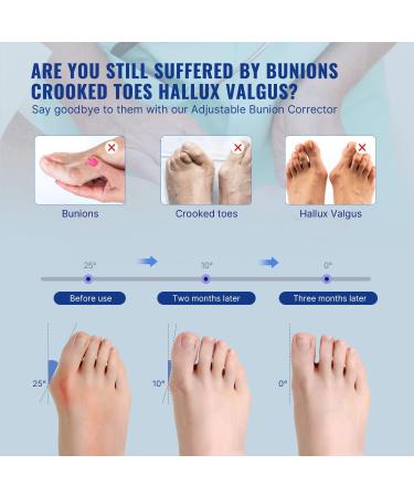 Fit Geno Bunion Corrector for Women Big Toe Adjustable for Men Toe Straightener Bunion Relief Foot Brace Splint Pain Relief Protector Hallux Valgus Corrector(Beige) - Buy Online on GoSupps.com
