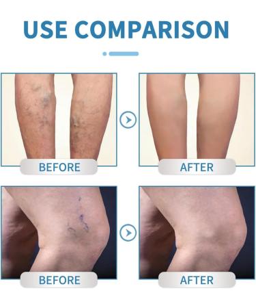 Calf Spray Veins Promoted Blood Circulation Nebulizer 30mlPortable Natural Soothing Vein Protection for Men Women Adults - Buy Online on GoSupps.com