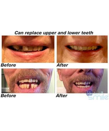 Instant Smile Multi-Shade Temporary Tooth Repair Kit - Patented Solution - Buy Online on GoSupps.com
