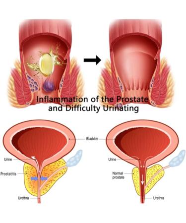 FBITE Heca Herbal Hemorrhoid Capsules - Fast Relief for Itching, Burning, and Pain - 1 Box - Buy Online on GoSupps.com