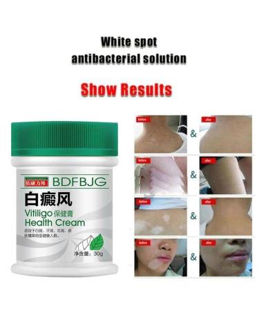Vitiligo Cream for White Spot Treatment - Natural Care for Skin Pigmentation & Melanocytes - 1.05 Ounce Pack - Buy Online on GoSupps.com