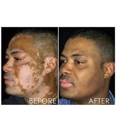 Vitiligo Removal Relief Spray - Skin Care Spray for White Spot and Vitiligo Relief (3pcs) - Buy Online on GoSupps.com