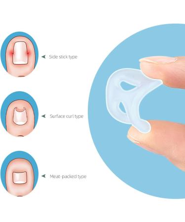 10PCS Silicone Ingrown Toenail Corrector Ingrown Toenail Corrector Set Nail Corrector Ring Silicone Ingrown Toenail Correcting Tool Washable Reusable Paronychia for Keep Nail He - Buy Online on GoSupps.com