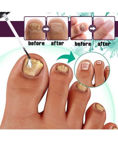 Fungal Nail Treatment Plant Essence Treatment Solution 30ML Special Nail Care Solution Athlete's Foot Toenails Broken Nails And Discolored Nails Restore Healthy Nails - Buy Online on GoSupps.com