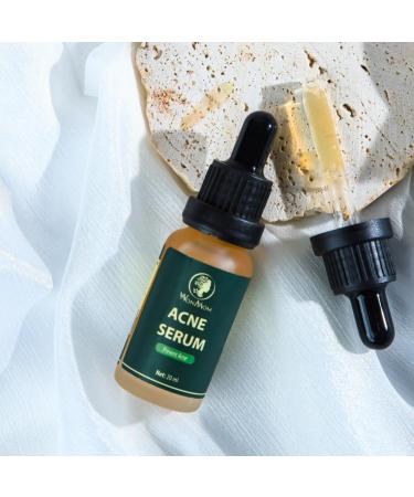 Buy Acne Serum (0.7 fl oz) | Fast International Shipping & Clear Skin Solution - Buy Online on GoSupps.com