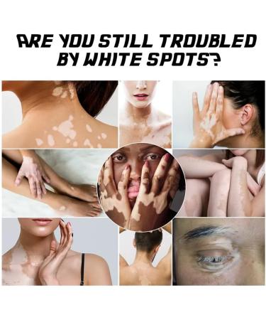 USLEAN Kolmax Vitiligo Soothing Ointment 20g - Psoriasis and Vitiligo Cream for All Skin - Buy Online on GoSupps.com