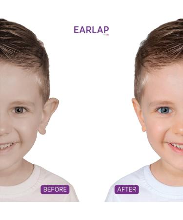 Kids Ear Corrector - Protruding Ear Sticker for 12-72 Months | Non-Surgical Ear Pinning | 20 Correctors + 10 Solaps - Buy Online on GoSupps.com
