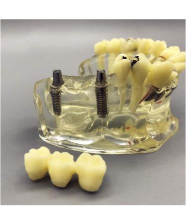 Fhuili Teeth Implant Model - Removable Chewing Gum & Prosthesis - Half-Port Bridge Restoration for Study & Recovery - Buy Online on GoSupps.com