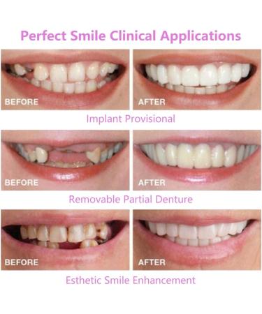 Congming-Huajia Temporary Cosmetic Veneer Teeth - Comfortable Dental Solutions for Bad Teeth | International Shipping Available - Buy Online on GoSupps.com