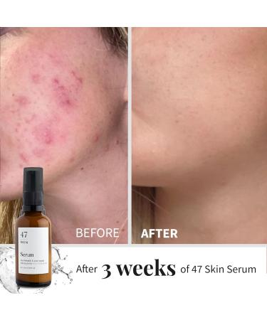 47 Skin Silver Chitoderm Anti Blemish Scar Repair Serum 100ml - Hydrating Face Serum for Acne and Scars - Mandarin Scent - Buy Online on GoSupps.com