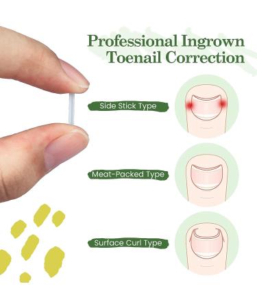 RMISODO 60-Piece Ingrown Toenail Corrector Strips - Professional Toenail Correction Patches for Curved Toenails - Paronychia Correction Pedicure Tool - Buy Online on GoSupps.com