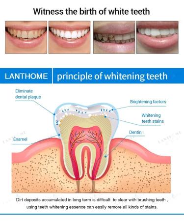 Teeth Whitening Pen & Stain Remover - 4 Pcs, 70+ Uses, 1 Month Supply - Buy Online on GoSupps.com