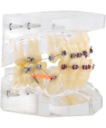 Orthodontic Treatment Weikeya Model | Harz Group PVC Teeth Learning - International Shipping Available - Buy Online on GoSupps.com