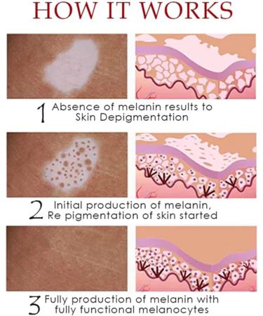 Vitiligo Treatment Spray - Skin Pigmentation Care & White Spot Reduction (2pcs) - Buy Online on GoSupps.com