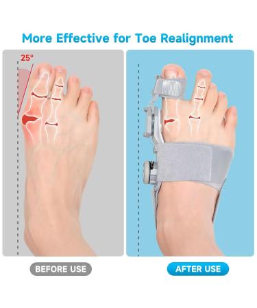 Premium Bunion Corrector for Women & Men - Adjustable Big Toe Brace with Gel Separators for Pain Relief - Universal Left & Right Foot Support (Grey - Buy Online on GoSupps.com