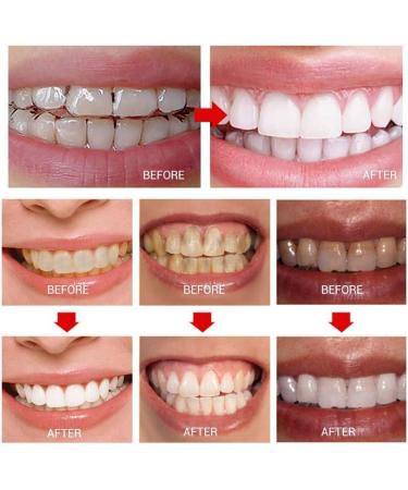 Henylas Tooth Whitening Stripes - Pain-Free Home Bleaching Kit | 14 Professional Strips for Brightening Teeth - Buy Online on GoSupps.com