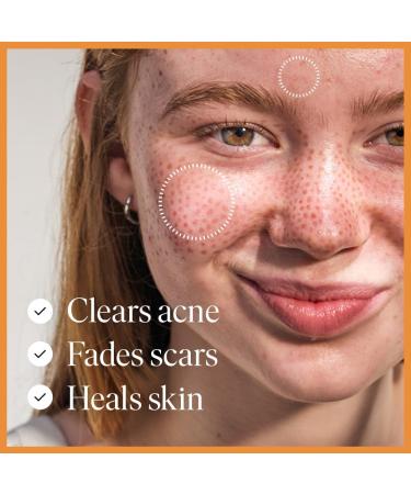 47 Skin Hydrating Face Serum for Acne and Scars - Anti-Blemish & Scar Repair Treatment | Silver Chitoderm, Smooth Moisturizer Serum for All Skin Types - 30ml - Buy Online on GoSupps.com