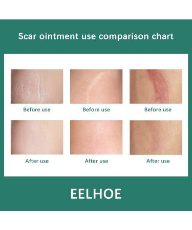 Skin Eternal Scar Removal Cream - Effective Stretch Mark and Scar Treatment for Men and Women - Great for Burns and Face Skin - One Size Fits All - Buy Online on GoSupps.com