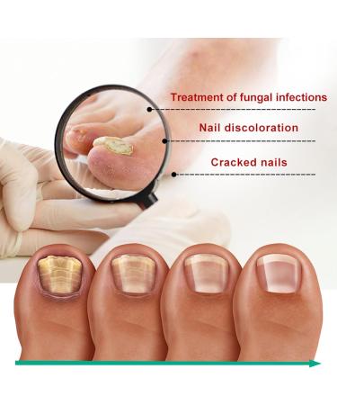 Kerassentials Huile de traitement antifongique pour ongles d'orteils restauration des ongles d color s et endommag s pour un aspect sain s r - Buy Online on GoSupps.com