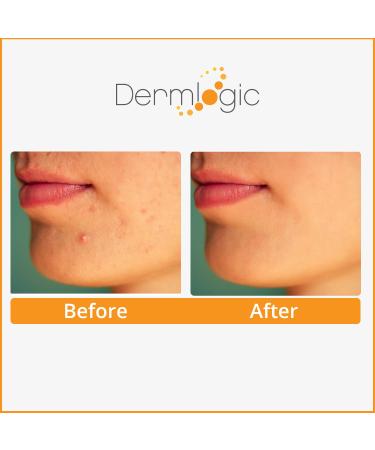 Dermlogic Acne Treatment Pads with Glycolic, Lactic, Salicylic Acid for Oily Skin, Clogged Pores, and Breakouts - Removes Dark Spots and Pimples on Face & Body - Buy Online on GoSupps.com