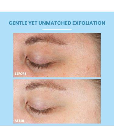 Gentle  GSL AHA/BHA Exfoliating Cleanser  - Glycolic Salicylic & Lactic Acid Face Wash for Acne Blackheads & Brightening Aloe + Hyaluronic Hydration Fragrance Free Sensitive Skin Safe - 4 fl oz - Buy Online on GoSupps.com