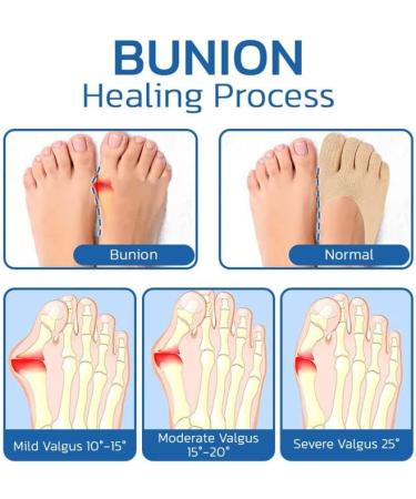 Sofeet Bunion Socks - New 2023 Projoint Antibunions Health Sock | Orthopedic Compression Bunions Relief | 4Pcs - Buy Online on GoSupps.com