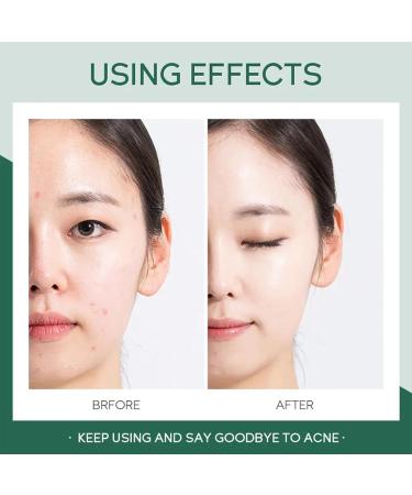 Anti Acne Cream for Acne Treatment and Spot Treatment with Nicotinamide Sodium Hyaluronate Aloe for Acne Prone & Sensitive Skin Reduce Redness Moisturiser Fade Acne Marks Oil Control - Buy Online on GoSupps.com