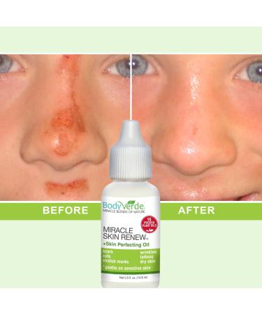 BodyVerde 100% Natural Miracle Skin Renew (Incredible multipurpose serum to support rapid skin healing in children and adults) - Buy Online on GoSupps.com