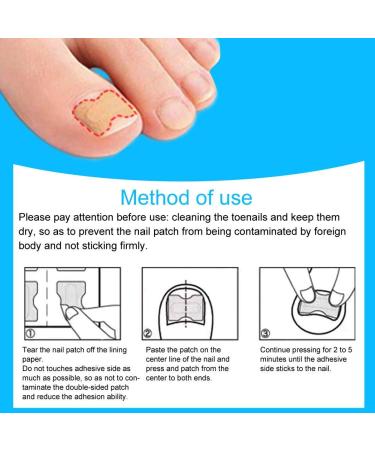 Toenail Correction Patch - Glue-Free Ingrown Toenail Sticker | 72 Pieces | Pedicure Tool for Men & Women - Buy Online on GoSupps.com