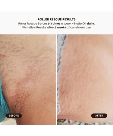 Bushbalm Ingrown Hair Routine - Roller Rescue Nude Oil and Nude Scrub Bundle - AHA & BHA - Exfoliating Soothing Cooling for Intimate Areas Underarms - Helps With Razor Bumps Ultimate(Trio Bundle) Roller-Nude Trio - Buy Online on GoSupps.com