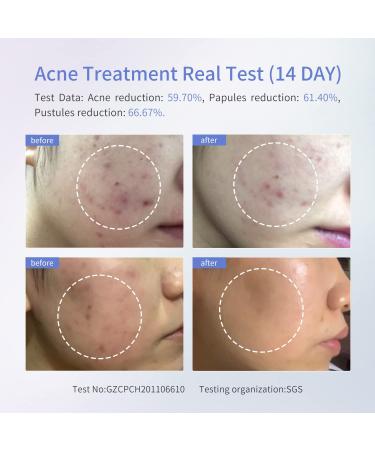 COSBEAUTY Plasma Acne & Blackhead Removal Facial Machine - White - Buy Online on GoSupps.com