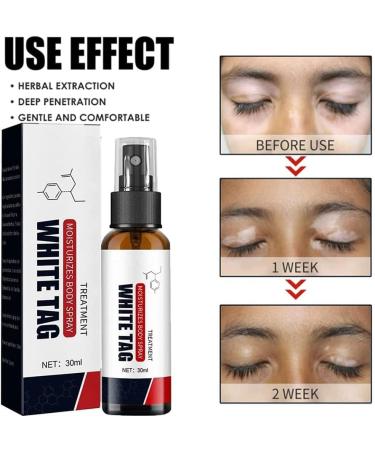 Dermax Psoriasis Treatment Spray Psoriasis Treatment Spray Kolmax Psoriasis Relief Spray Scalp Psoriasis Treatment Spray 30ml Psoriasis Treatment Spray (3 PCS) - Buy Online on GoSupps.com