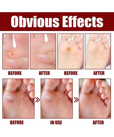 Hsadav GFOUK Foot Corn Removal Gel | Extra Strength 10ml Cream for Feet | Corn Removers (2pcs) - Buy Online on GoSupps.com