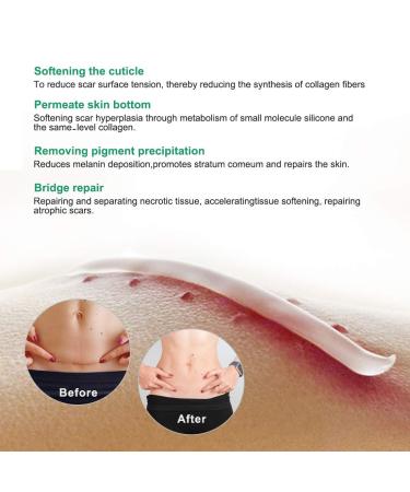 Scar Removal Cream for Old Scars, Stretch Marks & Burns - Natural Skin Repair for Acne Scars & Spots - Buy Online on GoSupps.com