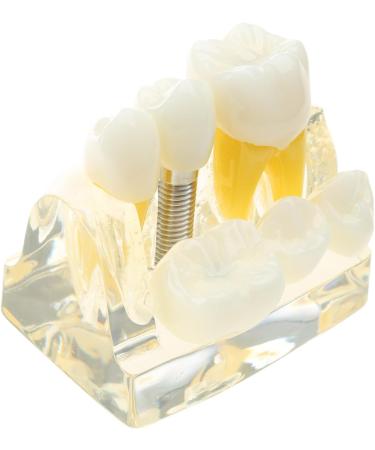 Implant Model Removable Bridge - Educational Teeth Model for Dental Studies | Perfect for Demonstration Classes - Buy Online on GoSupps.com