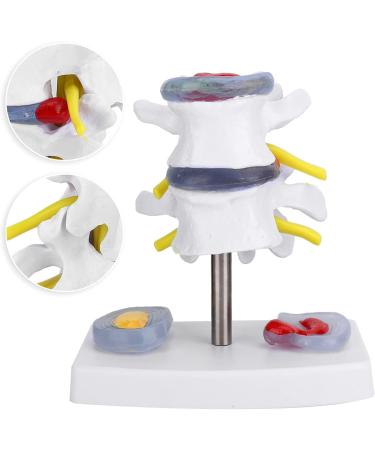 Anatomical Lumbar Intervertebral Disc Model - Spine Demonstration for Training & Education | International Shipping Available - Buy Online on GoSupps.com