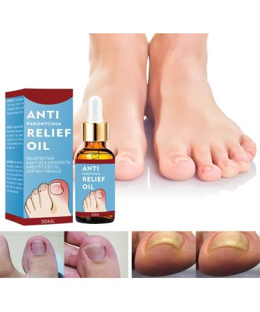 Ingrown Toenail Treatment Ingrown Toenail Treatment Drop Toenail Anti Paronychia Relief Oil Fungal Nail Treatment for Toenails Ingrown Toenail Treatment Nail Growth Treatment Nail Care (30ML) - Buy Online on GoSupps.com