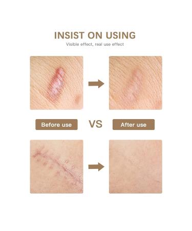 COHEALI Silicone Scar Strips Silicone Scar Removal Sheet 1 Roll Scar Removal Tapes Scarring Patches Soften Flattens Scars Keloids Resulting from Post Surgery Injury Burns Scar Tape - Buy Online on GoSupps.com