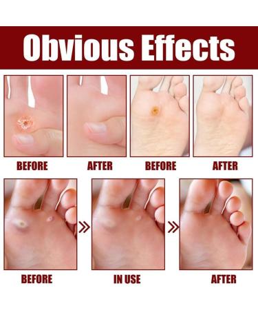 VERAMY Foot Corn Removal Extra Strength Gel - Quick Corn Remover Liquid (3PCS) - Buy Online on GoSupps.com
