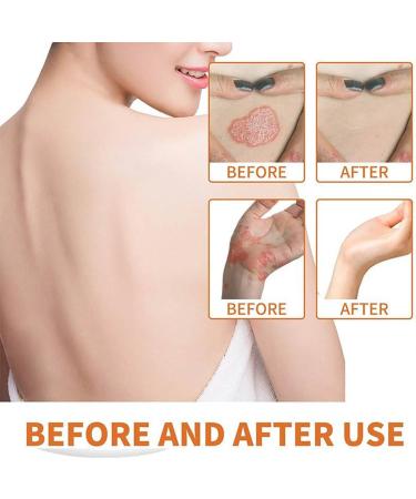 RENTANAC Bee Venom Psoriasis Cream Bee Venom Cream Psoriasis Cream New Zealand Bee Venom Cream Honey Bee Psoriasis Cream for Women Men - Buy Online on GoSupps.com